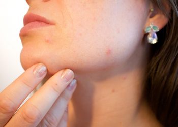 6 Tips on How to Clear up Acne